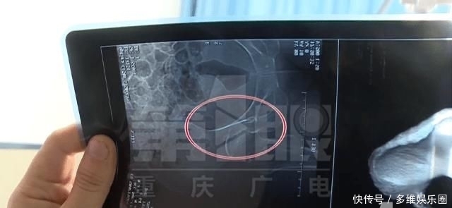  华宇广场|轮滑班“小哪吒”撞上六旬老人致骨裂 谁之责？