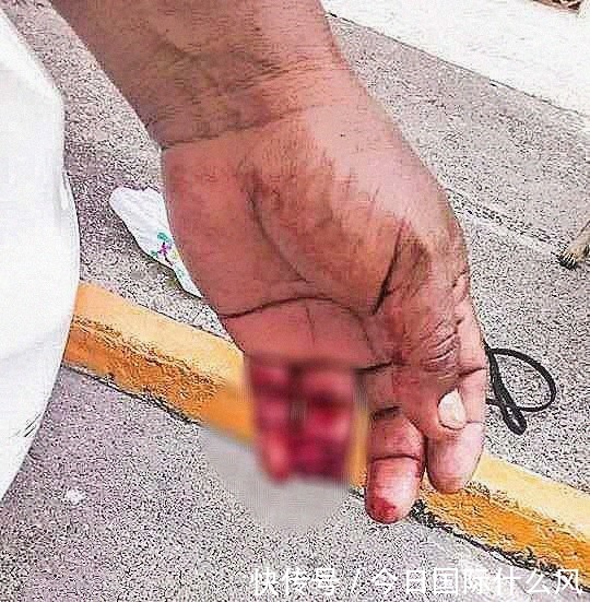 咬断|女子遭入室抢劫，硬生生咬断劫匪的食指，吐出来交给警察提取指纹