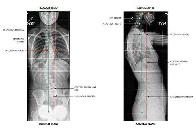  别晚|多数孩子存在“脊柱侧弯”，问题在于父母，矫正别晚于这个时间