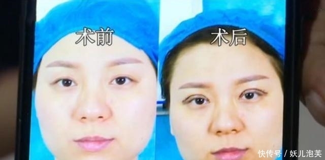 院长|花7万2做完双眼皮手术后,眼睛都睁不开了?院长:你就装吧