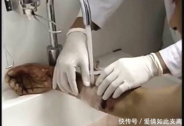  疫苗|为什么男孩被狗咬伤后, 打了三针狂犬病疫苗后, 还会发病身亡?